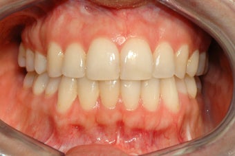 Female Orthognathic Surgery 990446
