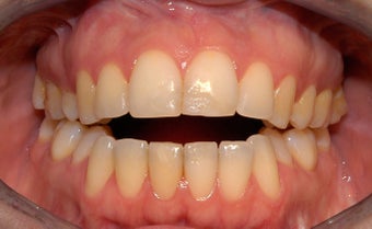 Female Orthognathic Surgery 990446