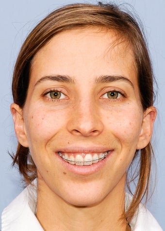 Female Orthognathic Surgery before 990446