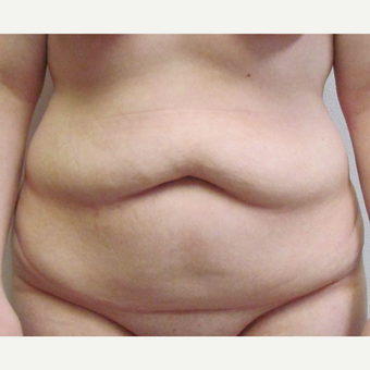 Skin Only Tummy Tuck for this 22 Year Old Woman before 3025251