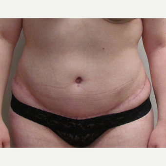 Skin Only Tummy Tuck for this 22 Year Old Woman after 3025251