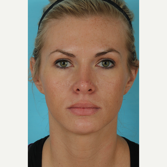 25-34 year old woman treated with Rhinoplasty after 3690995