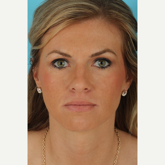 25-34 year old woman treated with Rhinoplasty before 3690995
