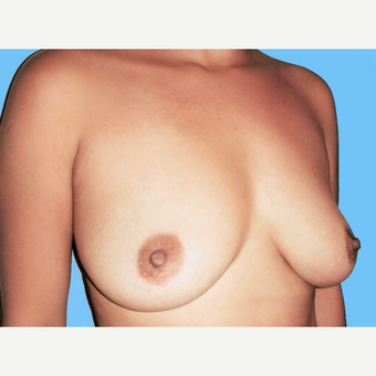Breast Augmentation before 3731630