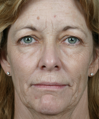 Thermage before 311110