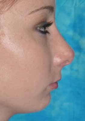 Female Rhinoplasty after 984049