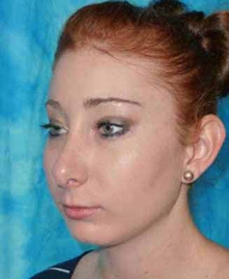 Female Rhinoplasty 984049