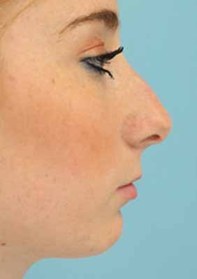 Female Rhinoplasty before 984049