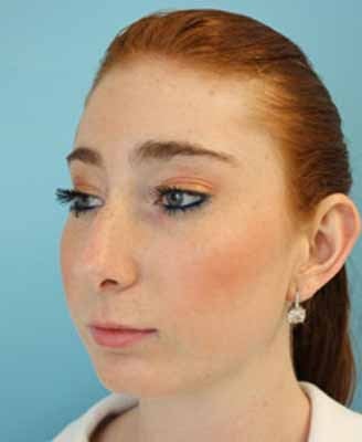 Female Rhinoplasty 984049