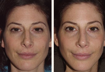 40 year-old female with a complex deviated nasal septum after 666462