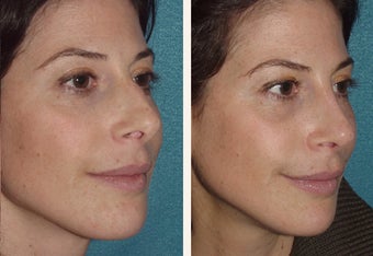40 year-old female with a complex deviated nasal septum 666462