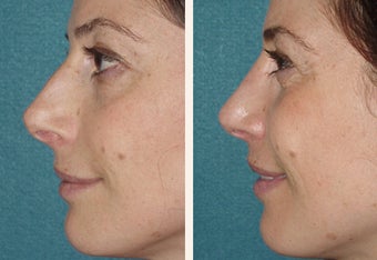 40 year-old female with a complex deviated nasal septum before 666462