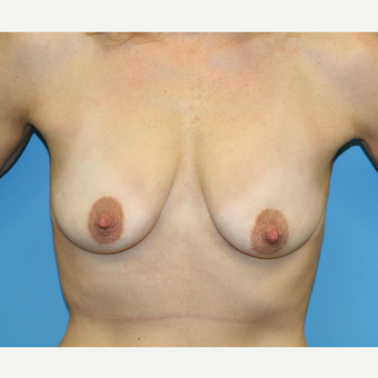 44 year old woman treated with Breast Augmentation before 3486881