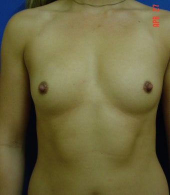 Breast Augmentation before 364529