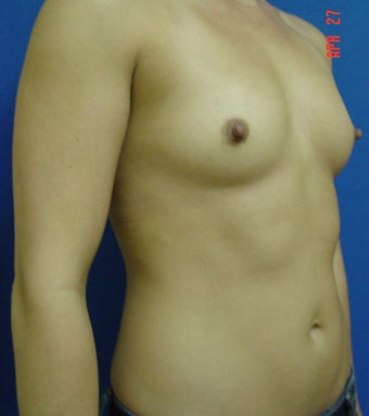 Breast Augmentation 364529