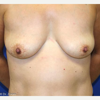 45-54 year old woman treated with Breast Lift with Implants before 3037368