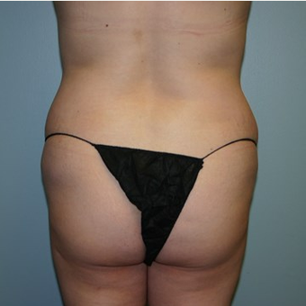 Brazilian Butt Lift before 3667523