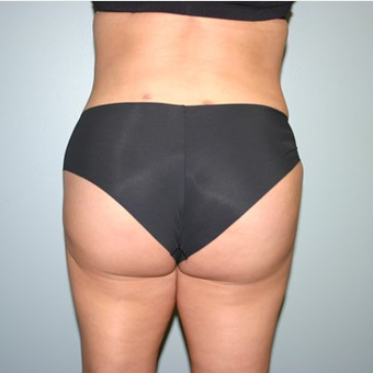 Brazilian Butt Lift after 3667523