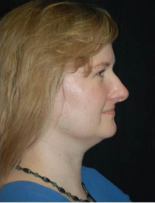 Brow Lift with Liposuction of the Neck before 660516