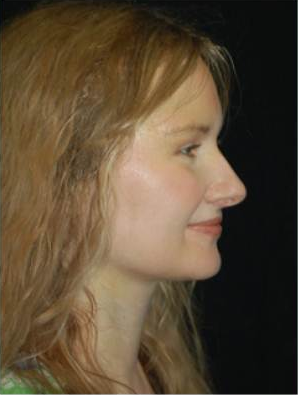 Brow Lift with Liposuction of the Neck after 660516