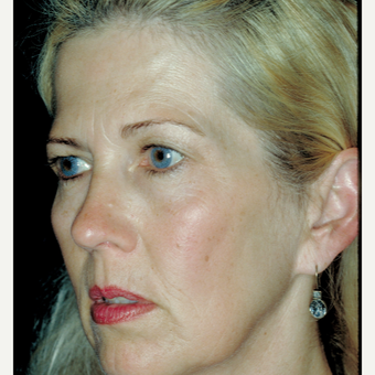 45-54 year old woman treated with Facelift - using a laser vertical technique before 3664773