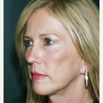 45-54 year old woman treated with Facelift - using a laser vertical technique after 3664773