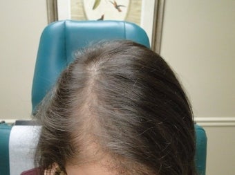 18-24 year old woman treated with PRP for Hair Loss after 2732195