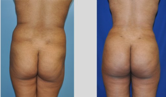 Buttock Augmentation before 271479