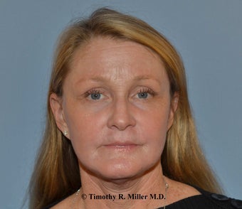 Wrinkle reduction with Ultra Pulse CO2 laser after 1448463
