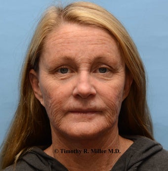Wrinkle reduction with Ultra Pulse CO2 laser before 1448463