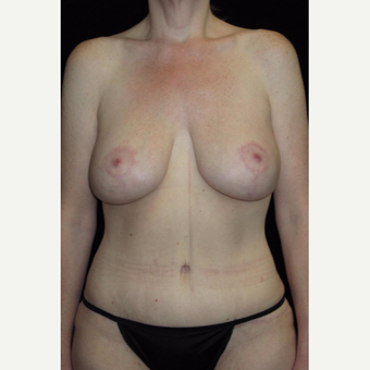 41 year old woman treated with Mommy Makeover after 3092785