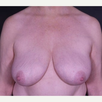 55-64 year old woman treated with Breast Implant Removal after 2600523