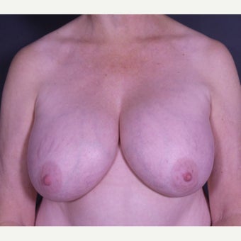55-64 year old woman treated with Breast Implant Removal before 2600523