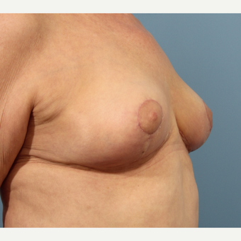 65-74 year old woman treated with Breast Reduction after 3059052