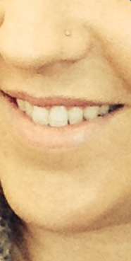 Filler for Lips before 1275824