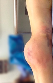 25-34 year old woman treated with Brazilian Butt Lift after 2482115