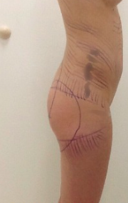 25-34 year old woman treated with Brazilian Butt Lift before 2482115