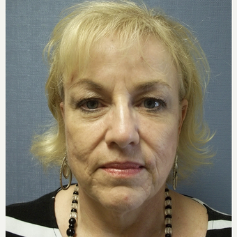 55-64 year old woman treated with Facelift before 3538803