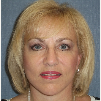 55-64 year old woman treated with Facelift after 3538803