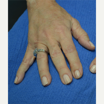 65-74 year old woman treated with Radiesse after 3725348