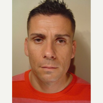 25-34 year old man treated with Botox before 3406110