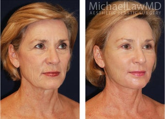 Full Facial Rejuvenation before 348508