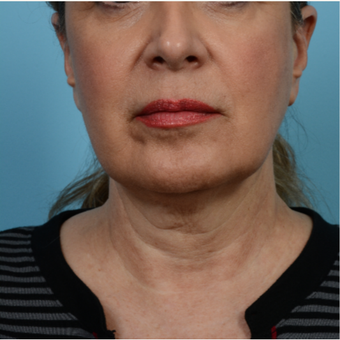 55-64 year old woman treated with Mini Lift before 3768661