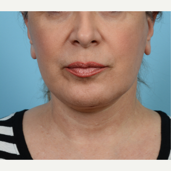 55-64 year old woman treated with Mini Lift after 3768661