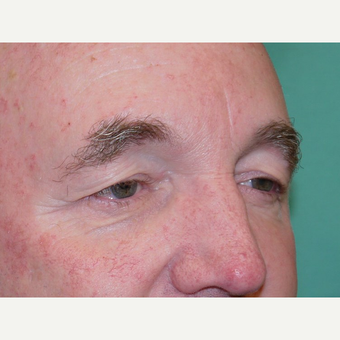 Eyelid Surgery before 3743978