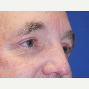 Eyelid Surgery after 3743978