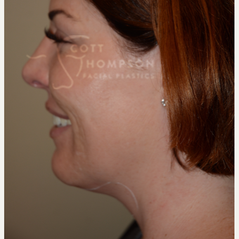 35-44 year old woman treated with Kybella before 3456218