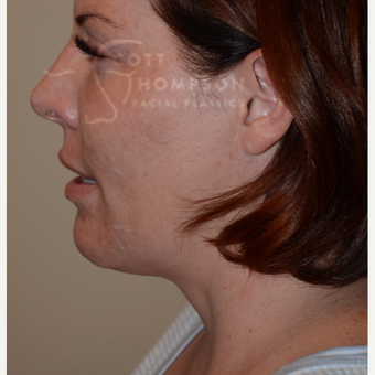35-44 year old woman treated with Kybella after 3456218