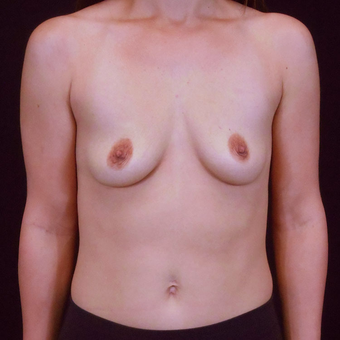 25-34 year old woman treated with Breast Augmentation before 3125530