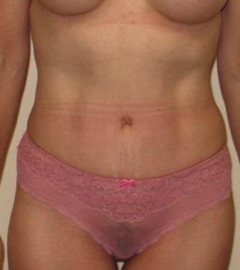 Tummy Tuck after 1219918